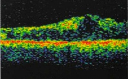 Модуль E20-10 в спектральной оптической когерентной томографии